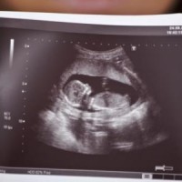 التصوير بالموجات الفوق صوتية عادي -ثلاثي الابعاد-رباعي الابعاد